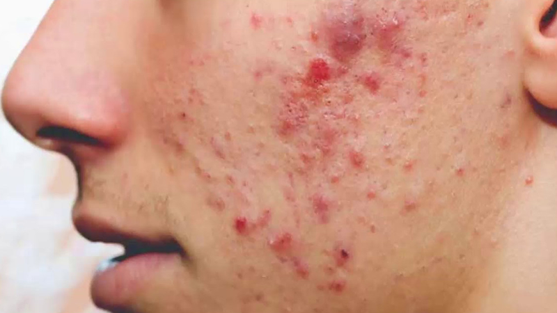 Soi da là gì? Cách nhận biết da qua máy soi da 3