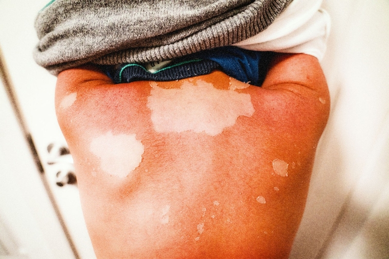 Muốn da “nhả nắng” nhanh - Thử ngay 5 mẹo sau! 1