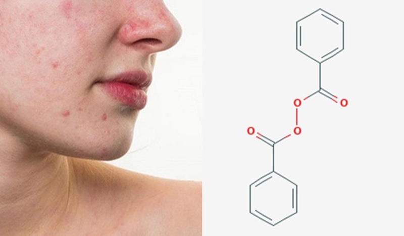 Muốn làn da sạch mụn: Sử dụng kem hỗ trợ điều trị mụn 2