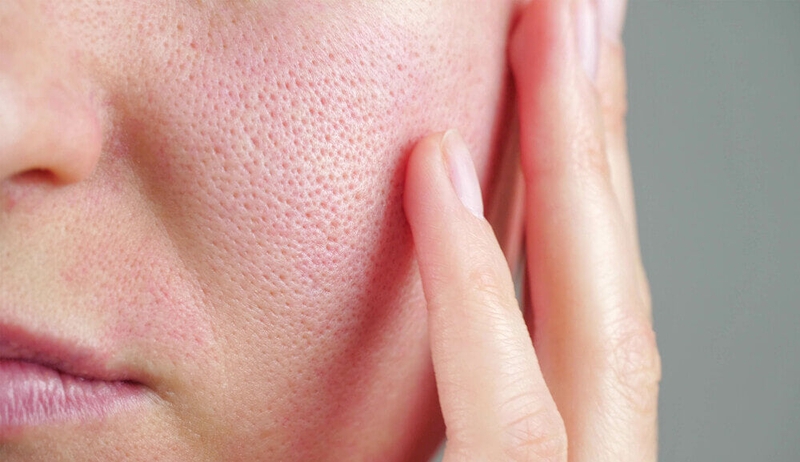 Muốn phục hồi da sau mụn - Làm ngay 4 điều này! 2