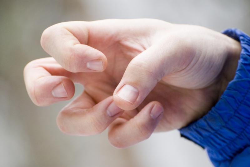 Myoclonus: Một dạng động kinh phổ biến ở trẻ em 2