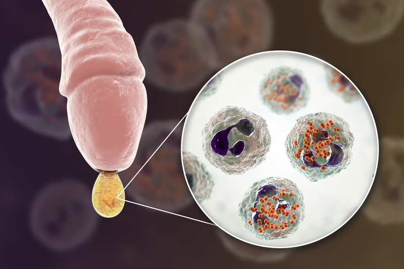 Hình ảnh nấm bao quy đầu ở nam giới