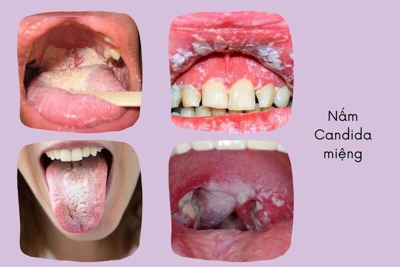 Nấm vòm miệng là bệnh gì? Nguyên nhân và cách điều trị 1