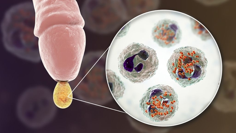 Nấm Candida ở nam giới: Mức độ nguy hiểm ra sao? 2