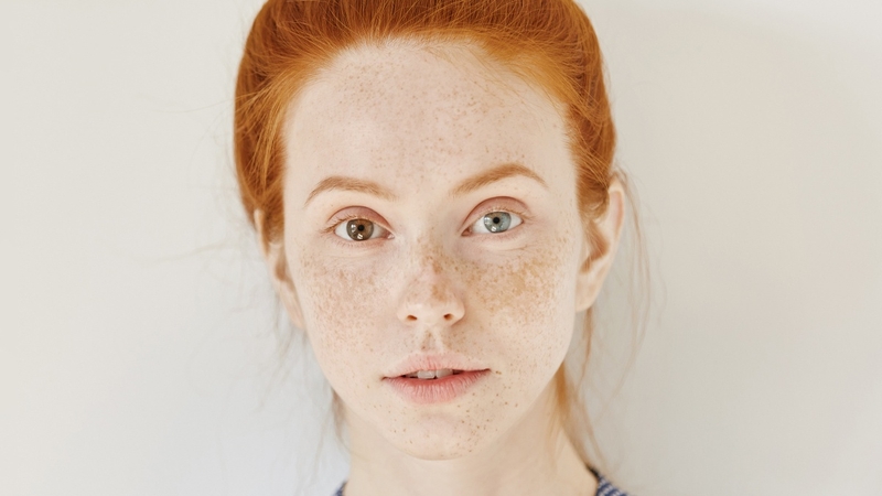 Nám cánh bướm là gì? Tìm hiểu nguyên nhân và phương án điều trị nám cánh bướm 1