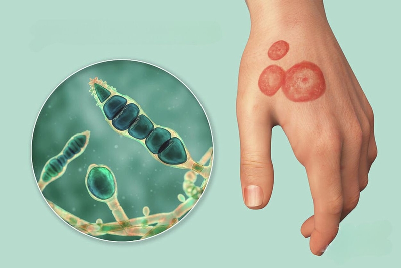 Bệnh nấm da có lây không? Cách giảm nguy cơ lây nhiễm nấm da 1
