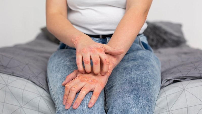 Bệnh nấm da có lây không? Cách giảm nguy cơ lây nhiễm nấm da 2