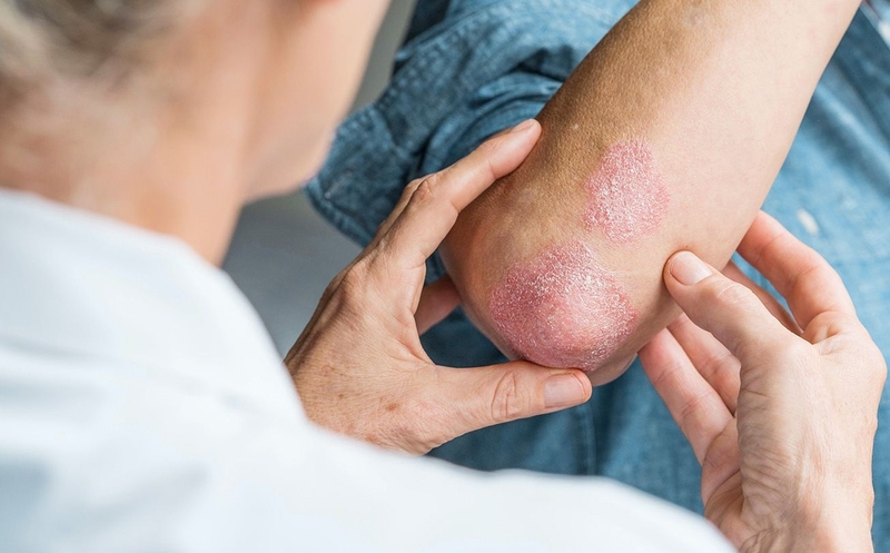 Bệnh nấm da có lây không? Cách giảm nguy cơ lây nhiễm nấm da 3