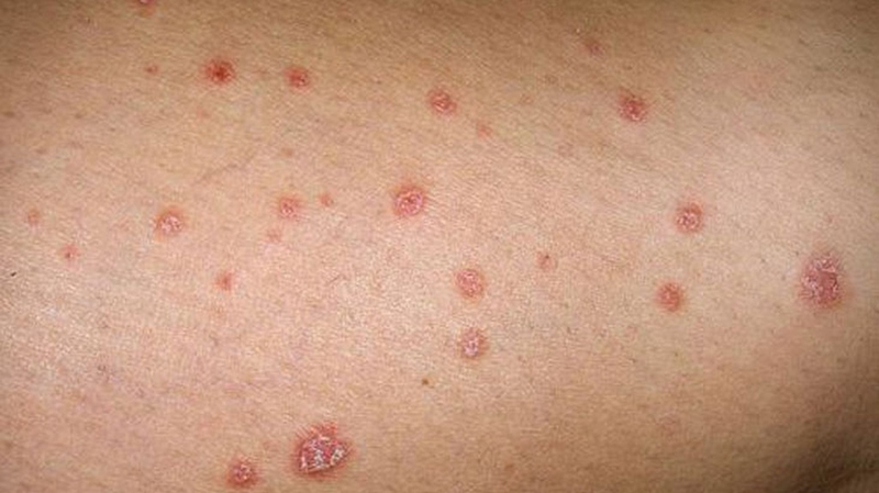 Nấm da đùi: Nguyên nhân, triệu chứng và cách điều trị hiệu quả 1