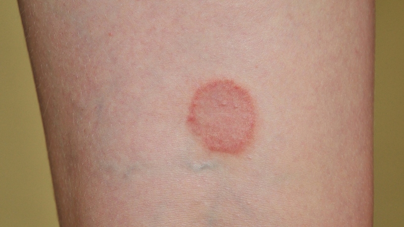 Nấm da đùi: Nguyên nhân, triệu chứng và cách điều trị hiệu quả 2