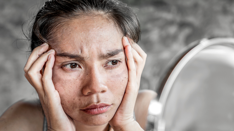 Nám da khi mang thai có tự hết không? Nám da khi mang thai thường có xu hướng mờ dần sau sinh