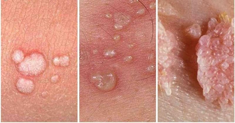 Sùi mào gà ở nam giới không ngứa, không đau và không chảy máu, mụn có thể chảy mủ màu trắng sữa