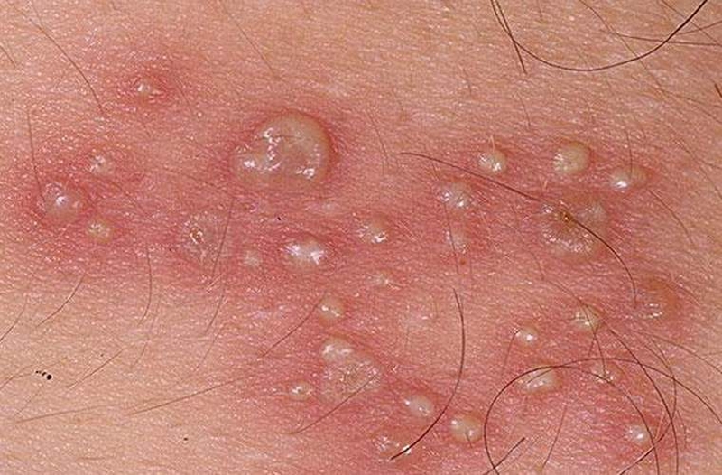 Mụn rộp sinh dục chủ yếu lây truyền qua đường tình dục và do virus herpes simplex (HSV) gây ra