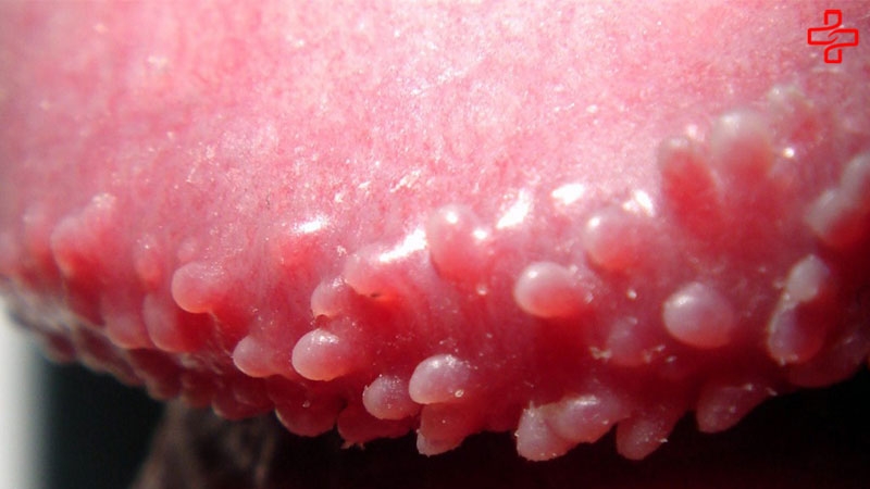 Nổi mụn nhỏ trắng ở rãnh bao quy đầu còn là triệu chứng của các bệnh xã hội như lậu, mụn rộp sinh dục, sùi mào gà hay viêm bao quy đầu