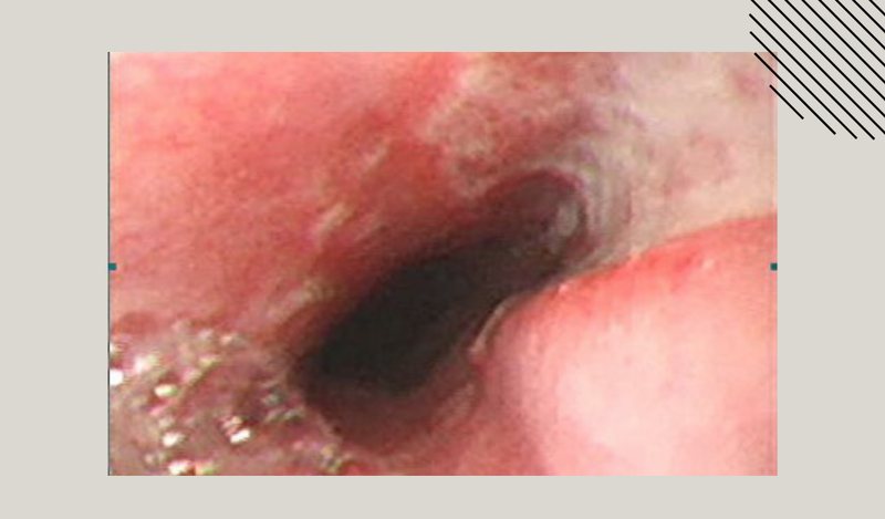 Nấm họng thực quản