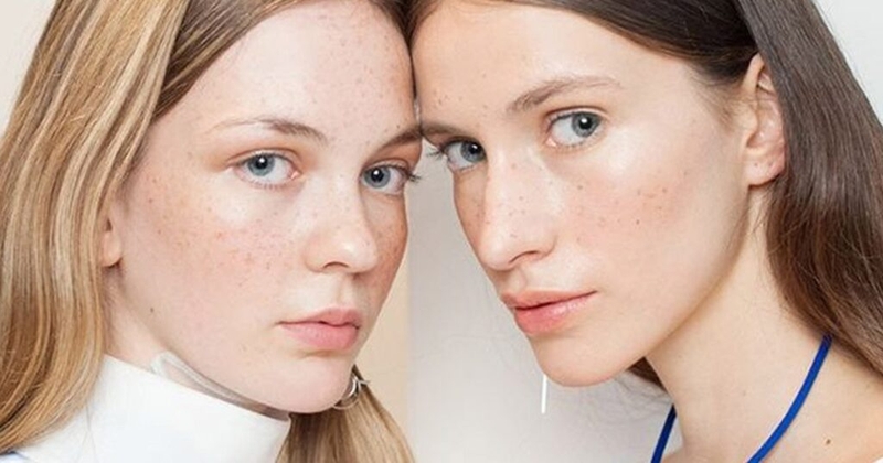 Nám hori là gì? Chữa dứt điểm được không? 4