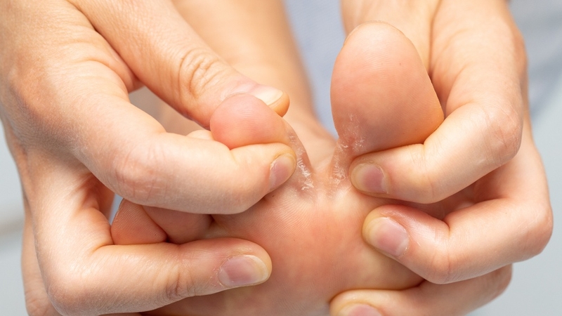 Nấm kẽ: Nguyên nhân, triệu chứng và cách điều trị 1