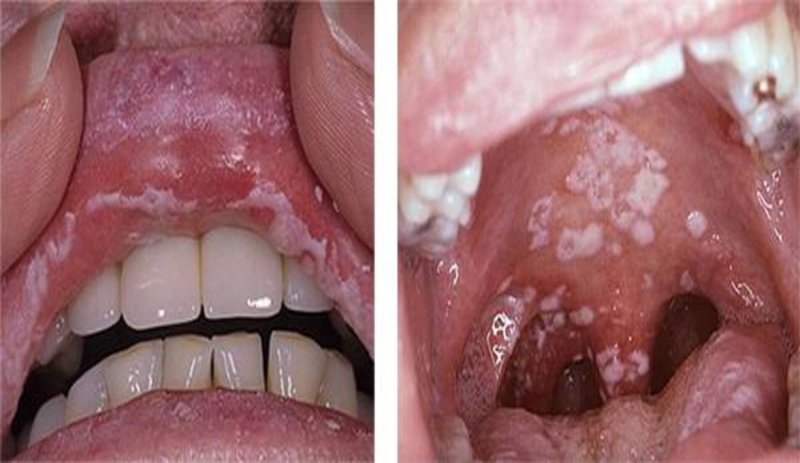 Nấm khoang miệng là bệnh gì? 1