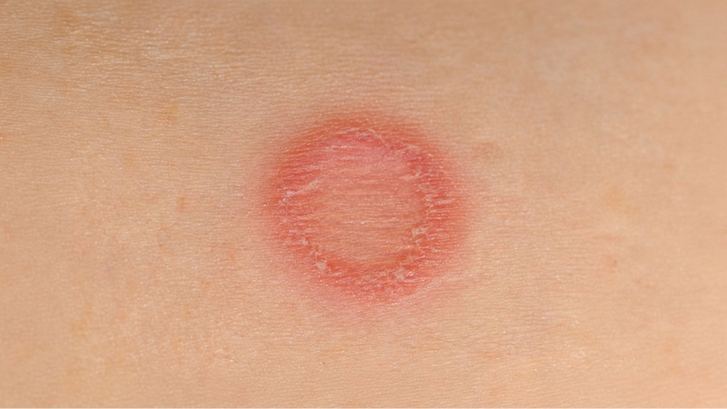 Tổn thương do nấm Microsporum thường có dạng vòng tròn kèm bong vảy và ngứa