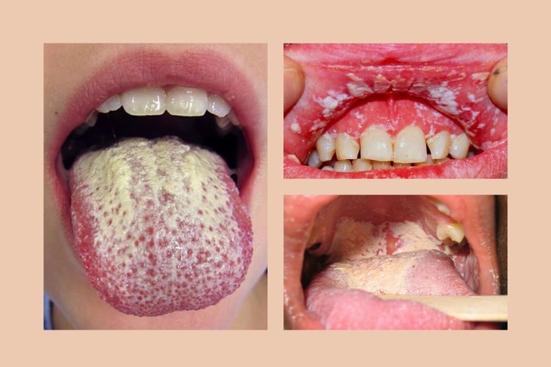 Nấm miệng và tưa lưỡi có khác nhau không? 2