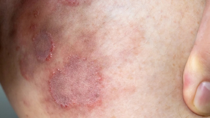 Nấm mông: Nguyên nhân, biểu hiện và cách điều trị 1