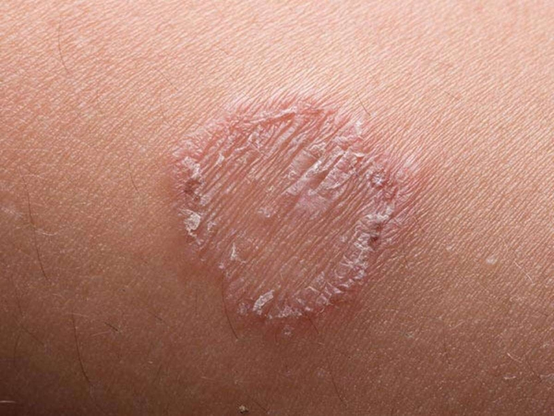 Nấm mông: Nguyên nhân, biểu hiện và cách điều trị 2