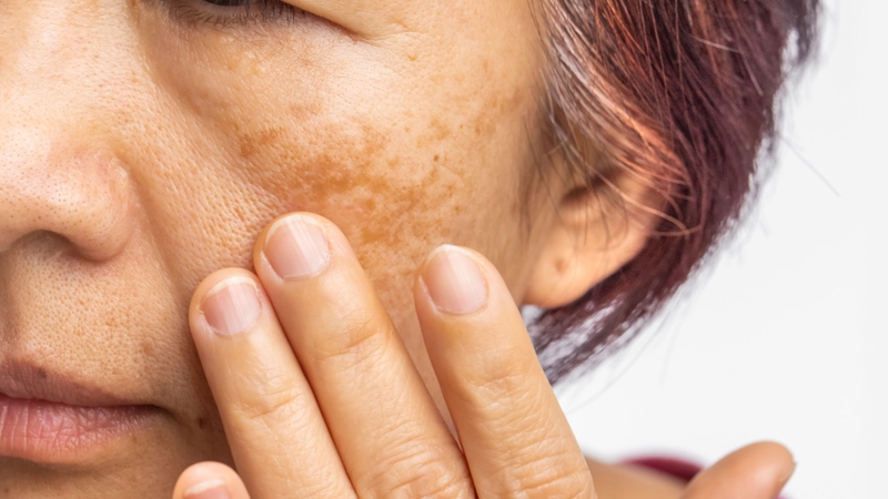 Nám nhẹ 2 bên gò má khắc phục như thế nào? 2