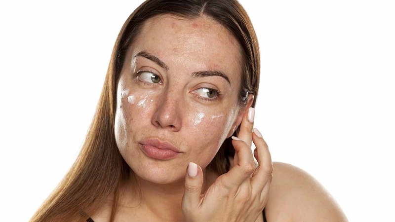 Nám nội tiết là gì? Điều trị và phòng ngừa ra sao? 6
