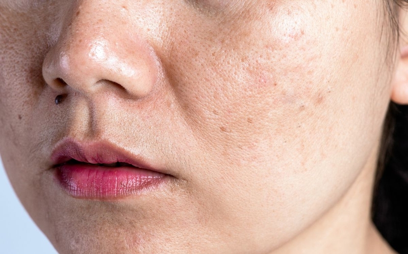 Nám nông là gì? Nguyên nhân, đặc điểm và cách điều trị 1