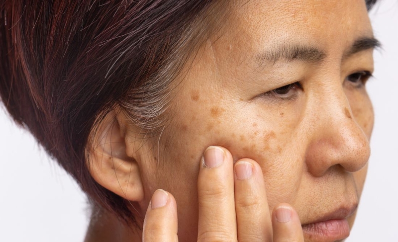 Nám thường xuất hiện ở độ tuổi nào? Cách phòng ngừa nám da 1