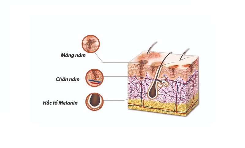 Nám thường xuất hiện ở độ tuổi nào? Cách phòng ngừa nám da 2