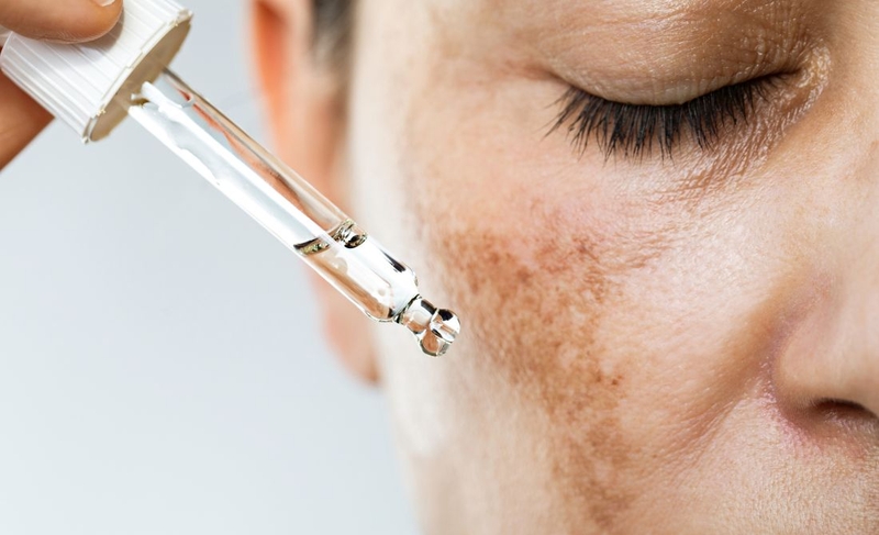 Nám thường xuất hiện ở độ tuổi nào? Cách phòng ngừa nám da 4