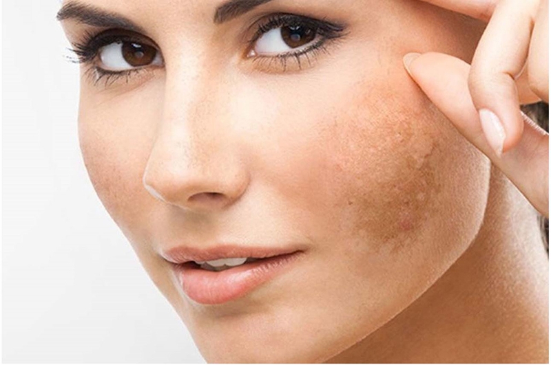 Nám xuất hiện do đâu? Mách bạn các phương pháp trị nám tốt nhất hiện nay 1