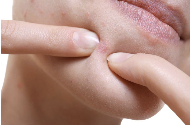 Nặn mụn bằng tăm bông và những điều cần biết 1