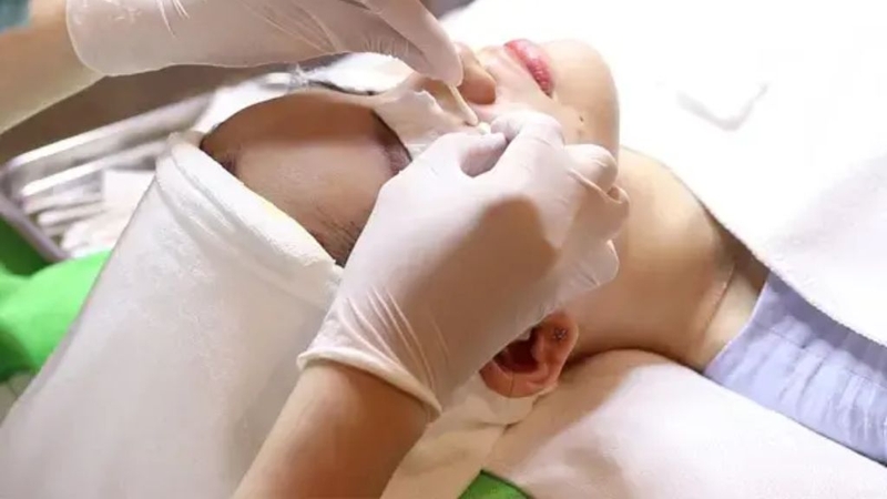 Nặn mụn bằng tăm bông và những điều cần biết 2