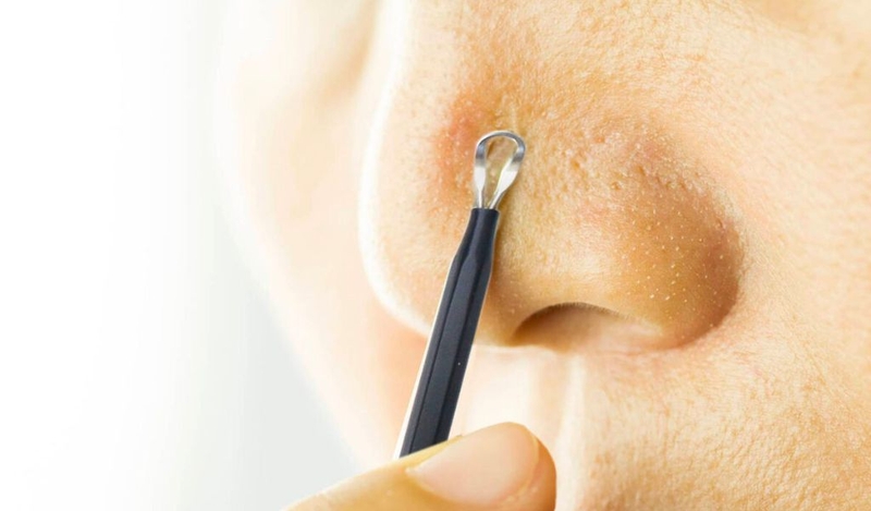 Nặn mụn ống tre là gì? Có nên thực hiện không? 2