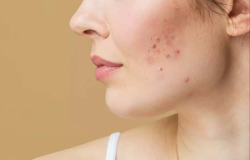 Nặn mụn xong có nên bôi kem chống nắng không là thắc mắc của nhiều người