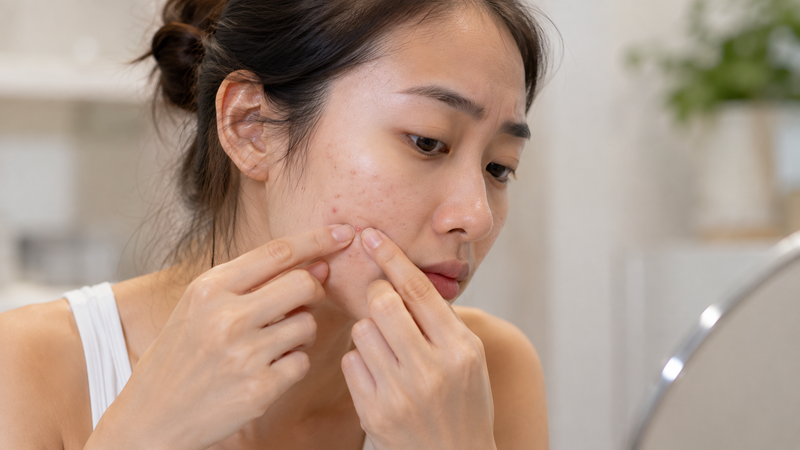 Nặn mụn xong có nên bôi mật ong không? là thắc mắc được nhiều người quan tâm