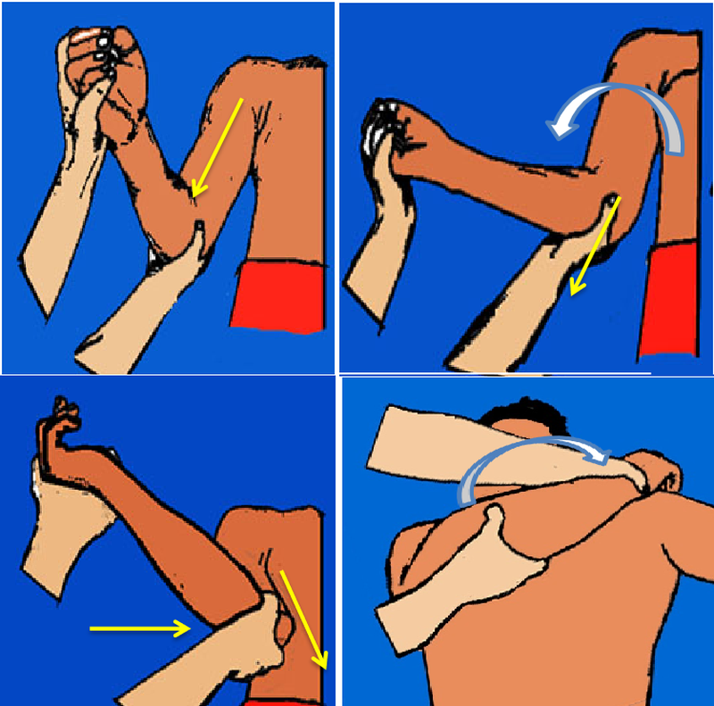 Các kỹ thuật nắn trật khớp vai phổ biến 4