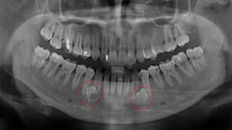 Nang chân răng là gì? Triệu chứng và cách điều trị 2