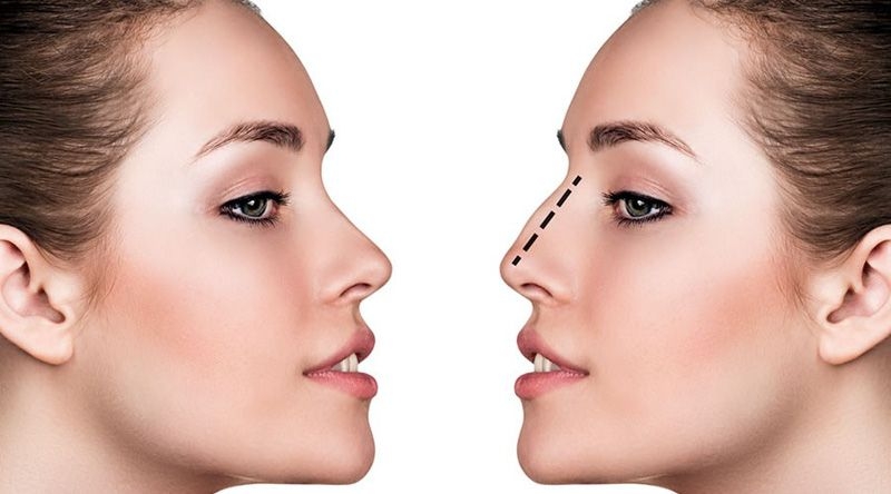 Nâng đầu mũi không gây ảnh hưởng