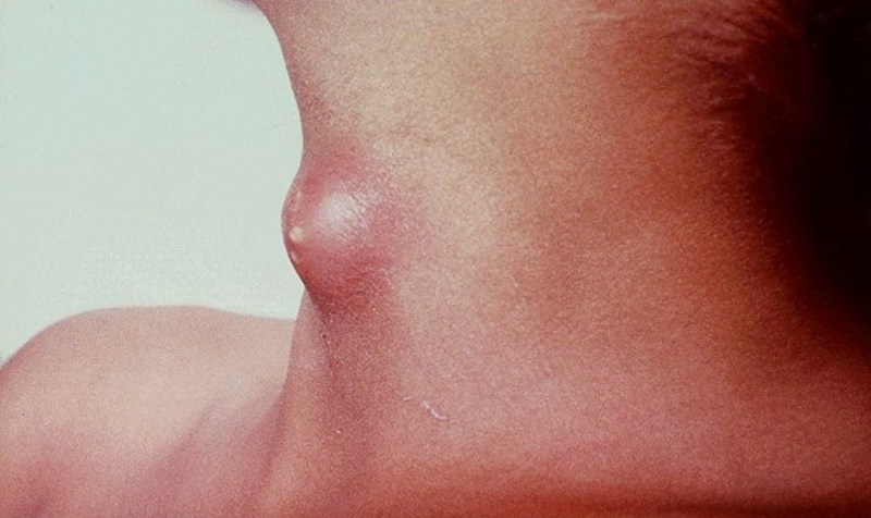 Nang khe mang là gì? Phân loại nang khe mang1