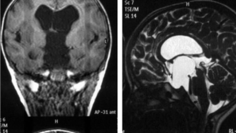 Nang màng nhện có nguy hiểm không? Tìm hiểu về triệu chứng, nguy cơ và điều trị hiệu quả 2