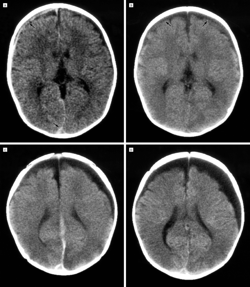 Nang màng nhện ở thai nhi là gì? 1