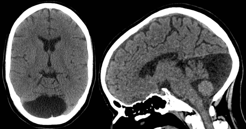 Nang màng nhện ở thai nhi là gì? 2