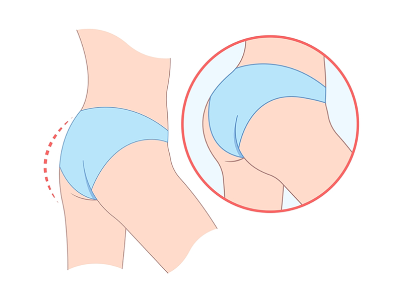 Nâng mông bằng mỡ tự thân có an toàn không? Giữ được bao lâu? 2