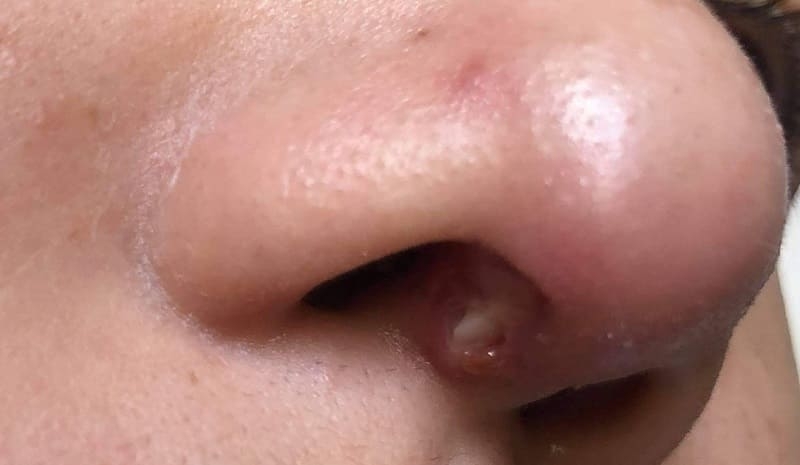 Phải làm gì khi nâng mũi bị hở vết thương? 3