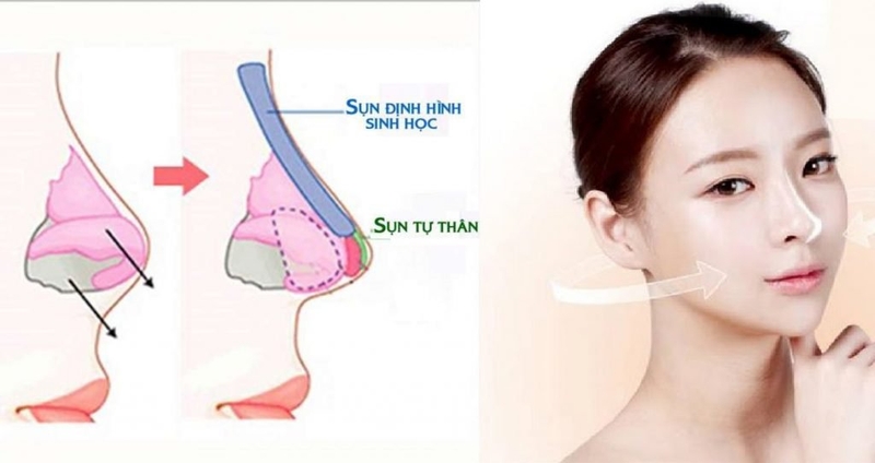 Sụn không tương thích khiến mũi bị sưng sau nâng