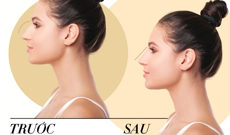 Nâng mũi bán cấu trúc có vĩnh viễn không? Có nên thực hiện không? 2