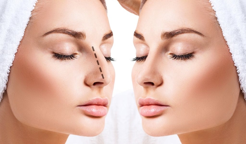 Nâng mũi bán cấu trúc là gì? Nâng mũi bán cấu trúc có lâu dài không? 1